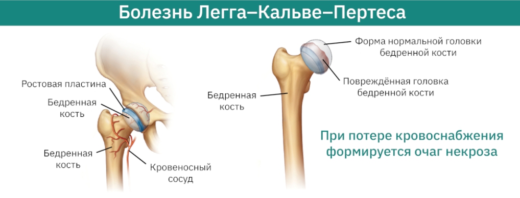 Болезнь Пертеса эффективные методы лечения у детей и подростков